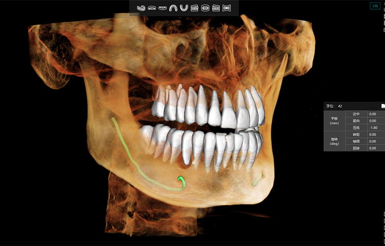 Tomografía CBCT 2.5D